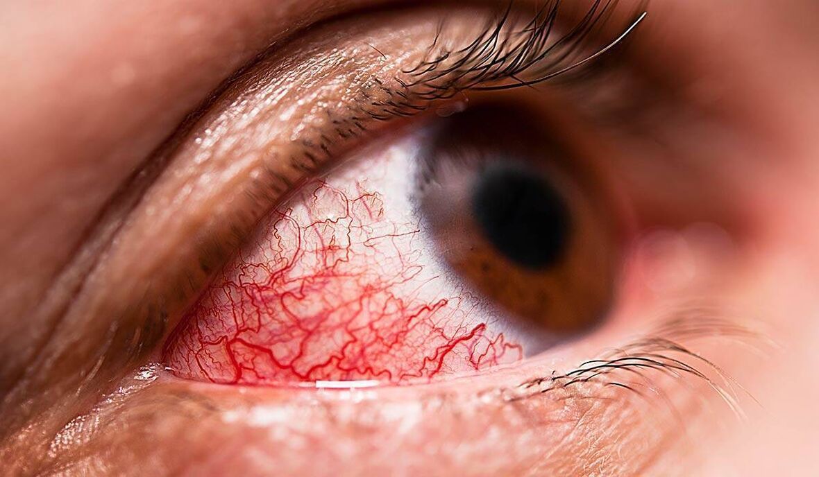 La retinopatia diabetica è una delle complicanze tardive del diabete